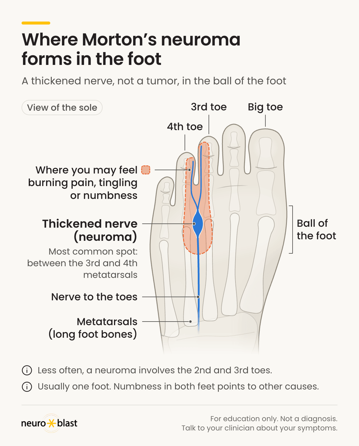 Sole-of-foot diagram (right foot): Morton's neuroma, a thickened nerve, most often forms between the 3rd and 4th metatarsal heads; burning pain, tingling or numbness may be felt there and in the 3rd and 4th toes, usually in one foot.